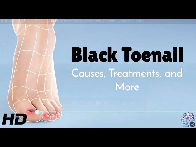 Black Toenail Problems? Learn Causes & Simple Solutions