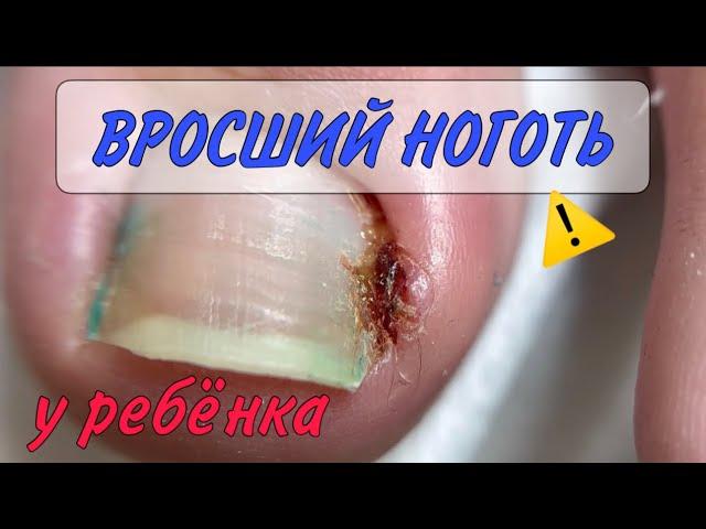 Вросший ноготь у ребенка/ воспаление на пальце/ прием у подолога