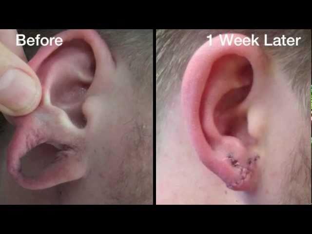 Stretched Earlobe Correction Testimonial - Before and After Photos - Aurora Clinics