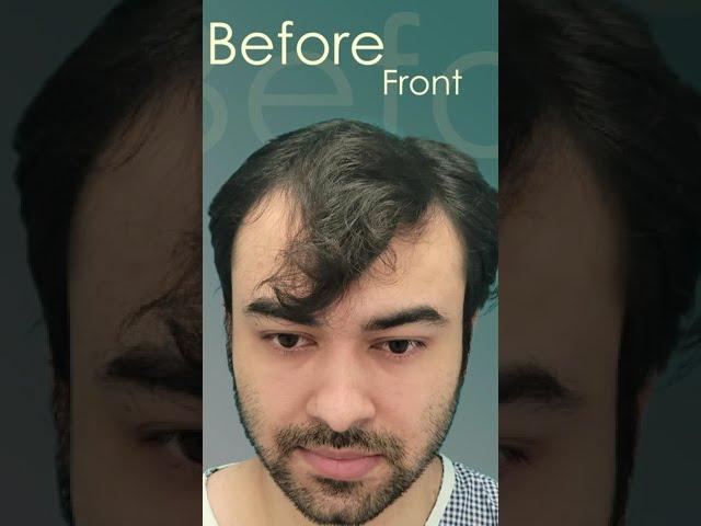 {2024) Hair Transplant Results Frontal + Crown #shorts