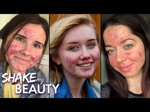 Living With Acne | SHAKE MY BEAUTY