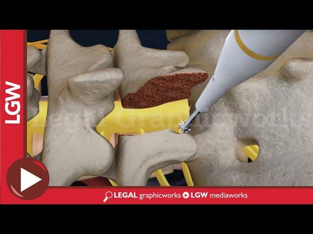 L5-S1 Lumbar Discectomy and Fusion Surgery 3D animation