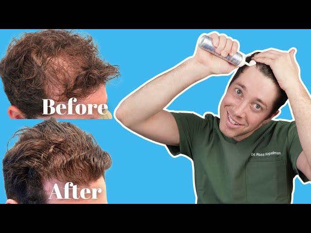 Benefits to Using Minoxidil for Hair Loss