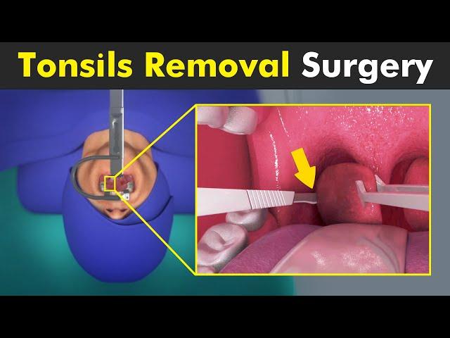 How Tonsillectomy is Performed? | Tonsils Removal Surgery