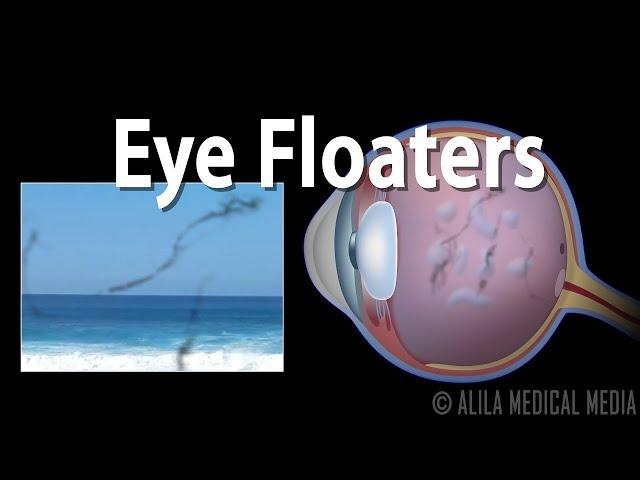 Eye Floaters and Flashes, Animation.