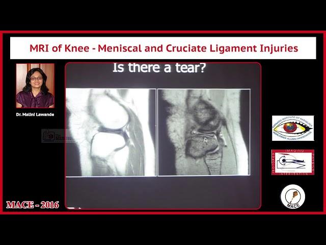 MRI of Knee - Meniscal and Cruciate Ligament Injuries