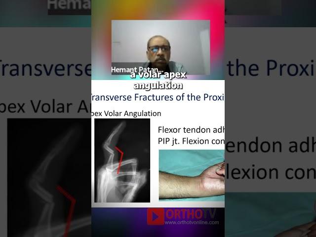 Closed K Wiring of Phalangeal Fractures - Dr Hemant Patankar