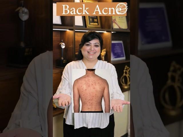 How to get rid of Back Acne? | Back Acne Treatment | Lacne Body Spray #shorts