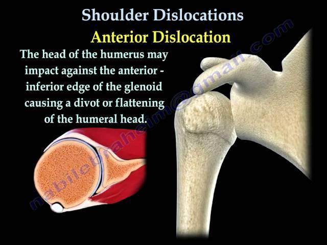 Shoulder Dislocations ,Everything You Need To Know - Dr. Nabil Ebraheim