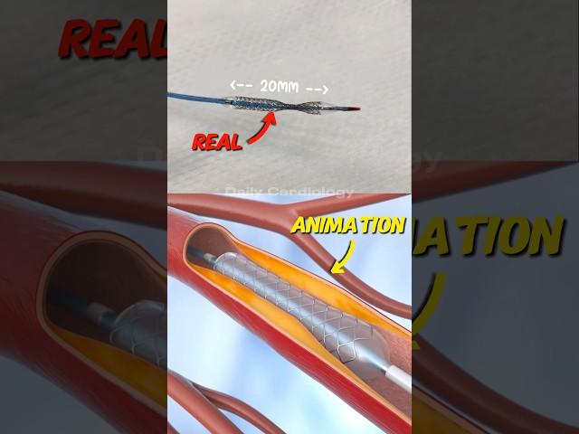 Real vs Animation: How a Stent is Placed in Angioplasty | Heart Procedure Explained #Shorts