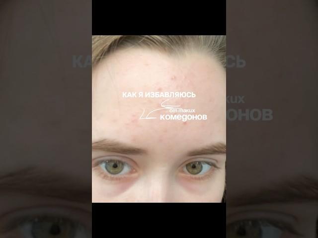 Как избавиться от закрытых комедонов