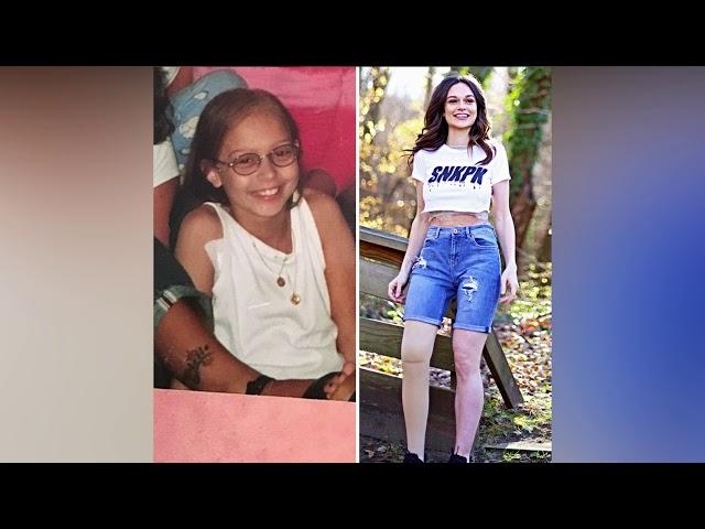 Girl Gets Her Leg Amputated At Age 11 Because Of Cancer, Becomes A Model 20 Years Later