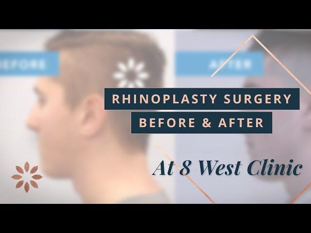 Rhinoplasty Transformations - Before & After Pictures | Dr. Buonassisi, 8 West Clinic in Vancouver