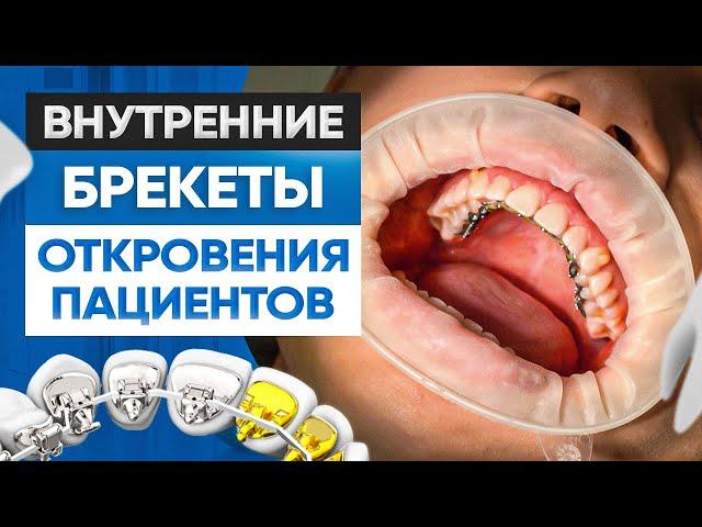 Внутренние брекеты. Откровения и отзывы пациентов клиники OrthoLike