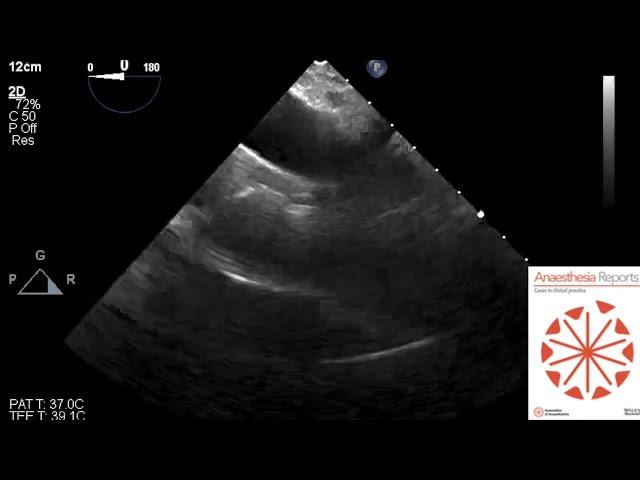 TOE echocardiography guided retrieval of shattered aortic cross-clamp from the mediastinum