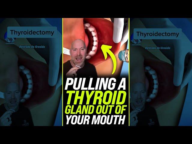 Pulling a Thyroid Out of Your Mouth  #shorts