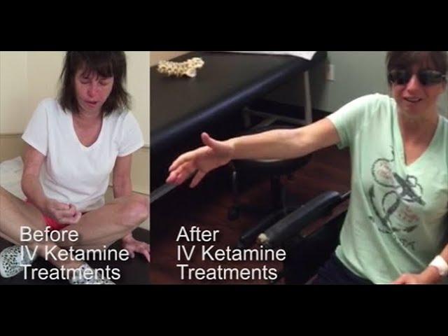 Dr. Hanna treats CRPS patient with his groundbreaking IVKetamine treatment