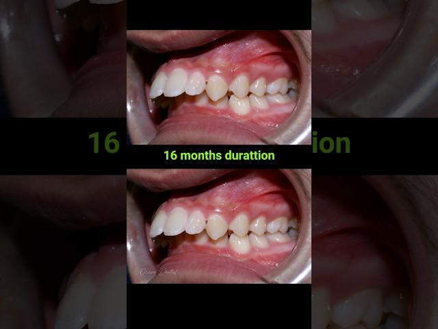 Braces for buck teeth, 16 months #braces #orthodontist #dentaltreatment #dentist