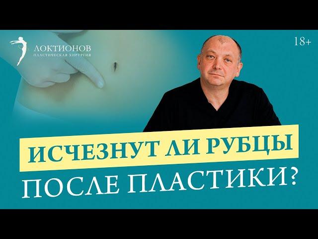 Как убрать рубцы после абдоминопластики? Пластика живота / 18+