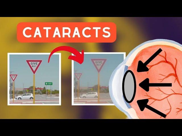 What CATARACTS do to your vision..