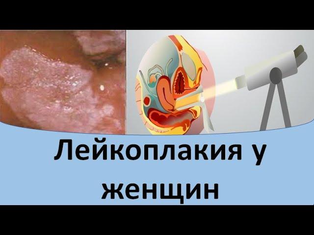 Лейкоплакия шейки матки и вульвы у женщин