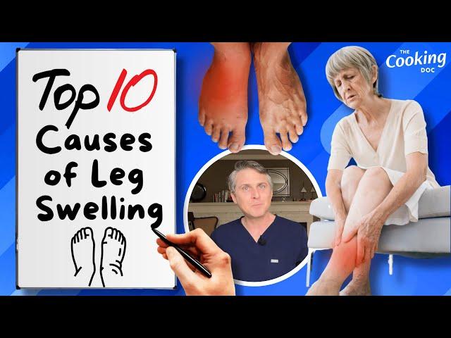 What Causes Leg Swelling? The Top Ten Reasons for Puffy or Swollen Legs!