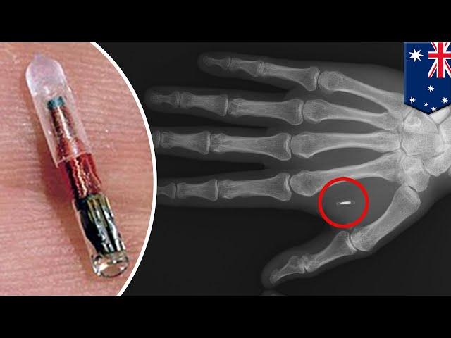 Microchip implants: Volunteers get injected with NFC chips for Melbourne tech festival - TomoNews