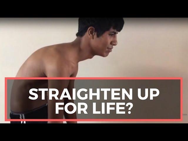 Gonstead Chiropractic Helps Teenager Acute Pain Extreme Kyphosis & Dead Leg - Chiropractor Meridian