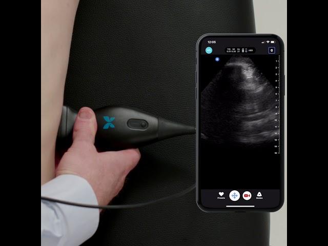 Ultrasound Education:  FAST Exam Basics, Left Upper Quadrant