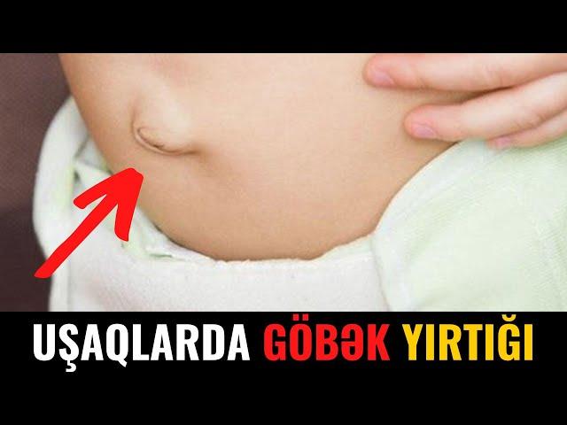 Uşaqlarda Göbək Yırtığı Zamanı Bunları ETMƏYİN!