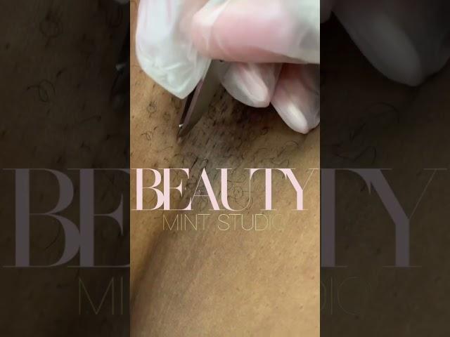 Ingrown Hair Removal