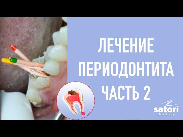 Treatment of periodontitis, second visit. Filling of tooth canals.