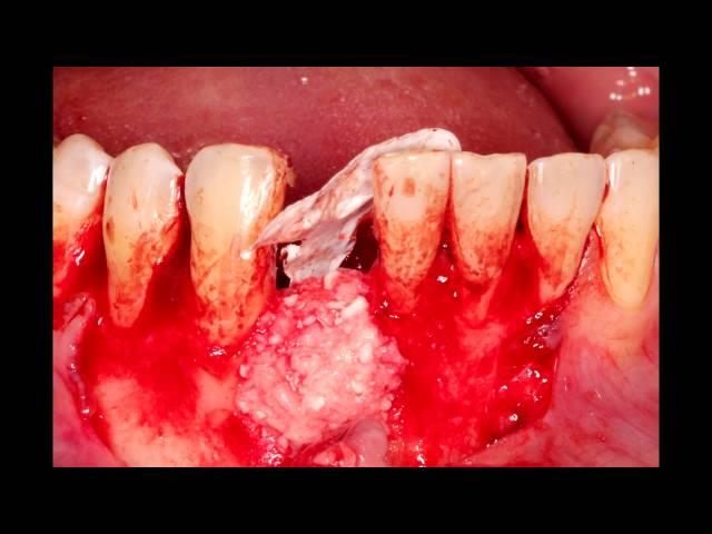 Guided Bone Regeneration by Dr. Oleg Ponomarev