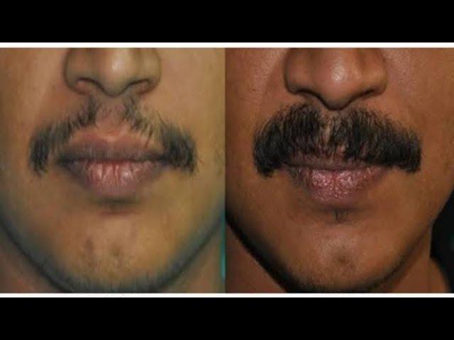 #Moustache#tretment#permanent#rksalon