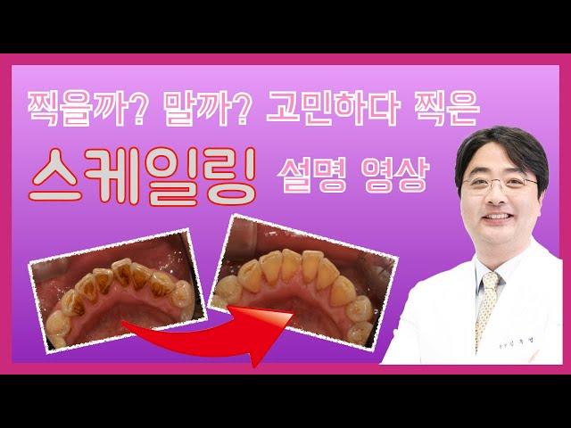 찍을까? 말까? 고민하다가 찍은 스케일링 설명 영상 - 보스톤스마트치과의원 김종엽 원장