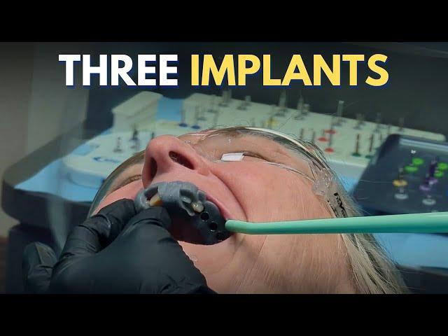 Planning to Placement: A Step-by-Step Dental Implant Surgery