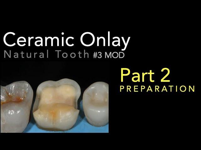 Lithium Disilicate Ceramics, Part  2: Ceramic Onlay Preparation