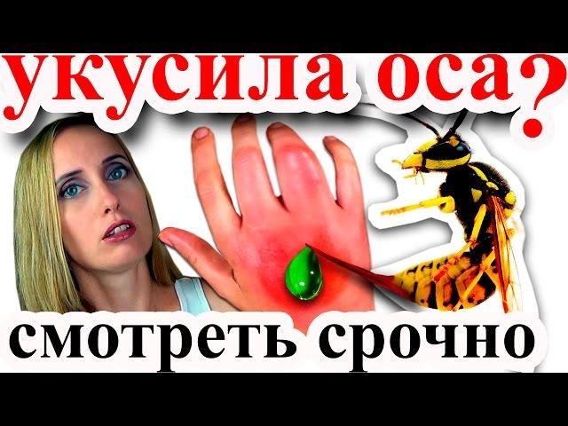 УКУС ОСЫ//ВАС УКУСИЛА ОСА?//СМОТРИТЕ ЧТО ДЕЛАТЬ ПРИ УКУСЕ ОСЫ!