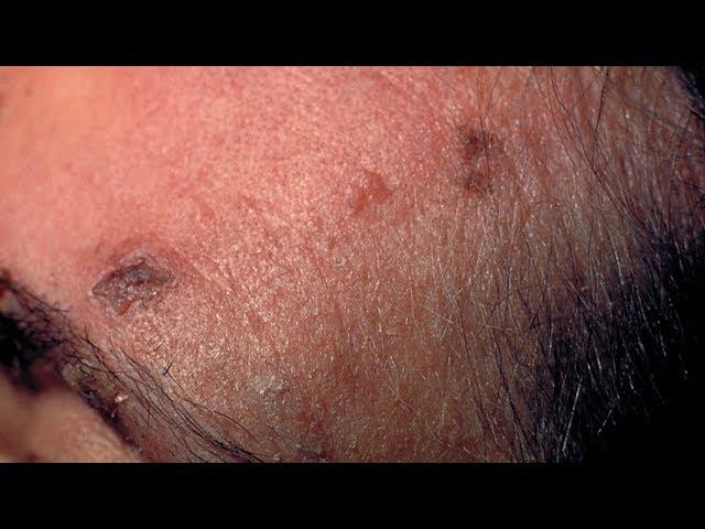 Mayo Clinic Minute: What are eye shingles?