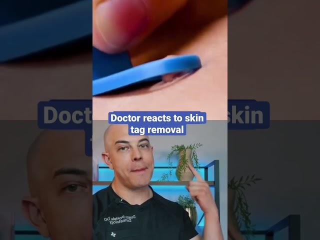 Doctor reacts to skin tag removal!