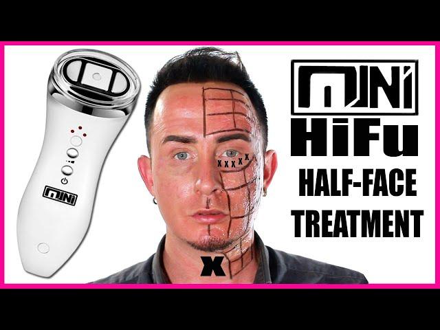 Home Ultherapy Mini Hifu Tutorial | High Intensity Focused Ultrasound Before & After