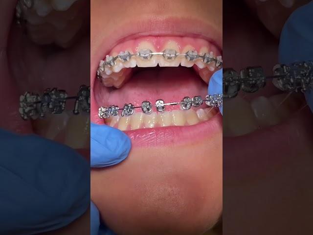 BRACES OFF‼️ #shullmanorthodontics #reels
