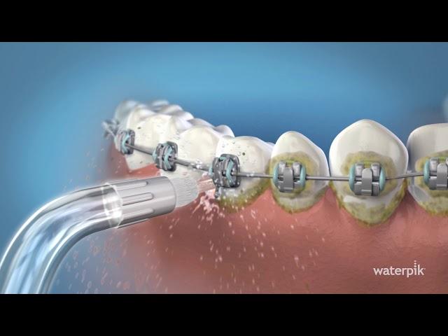 Waterpik™ Orthodontic Tip (OD-100E)