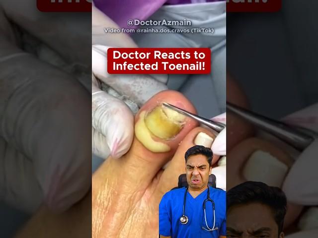  Doctor Reacts to Disgusting Nail Infection! (Paronychia Explained)