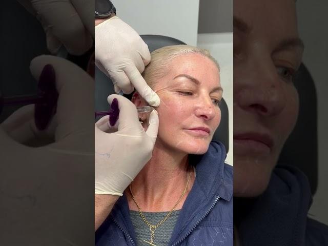 Cheek dermal filler | Newcastle Cosmetic Doctor | Performed by needle technique.