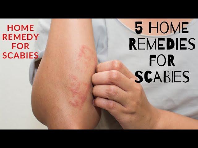 home remedy for scabies