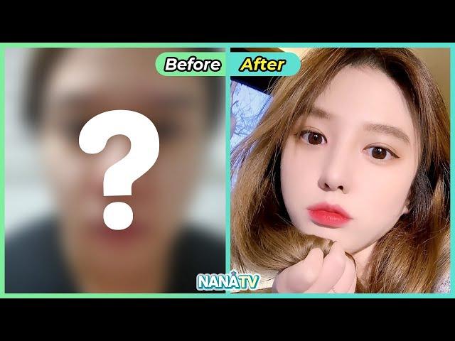 [SUB] Best 5 Plastic Surgery Before & After | Korean Beauty Transformation