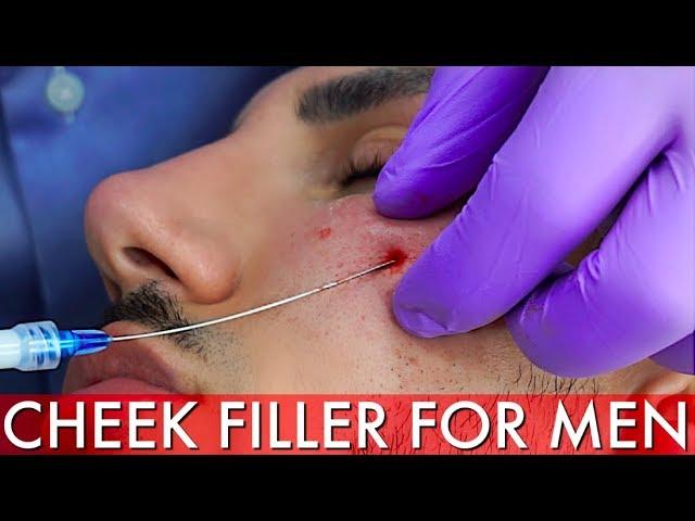 CHEEK FILLER FOR MEN | DR AYAD