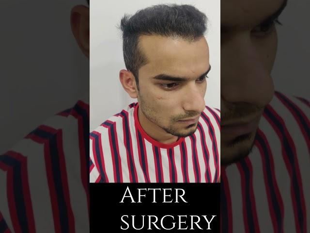 Hair transplant in indore | Amazing Hair transplant result #shorts #shortsfeed #viral #amazing