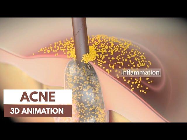 Acne basics | Pathophysiology & Treatment  | 3D Animation